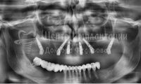 Восстановление зубов на верхней челюсти - Фотография 4